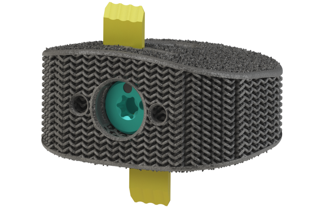 Nexus Spine Obtains a U. S. Patent that Addresses Flexible, Porous Interbody Devices and that Has a Priority Date Extending Back to 2015