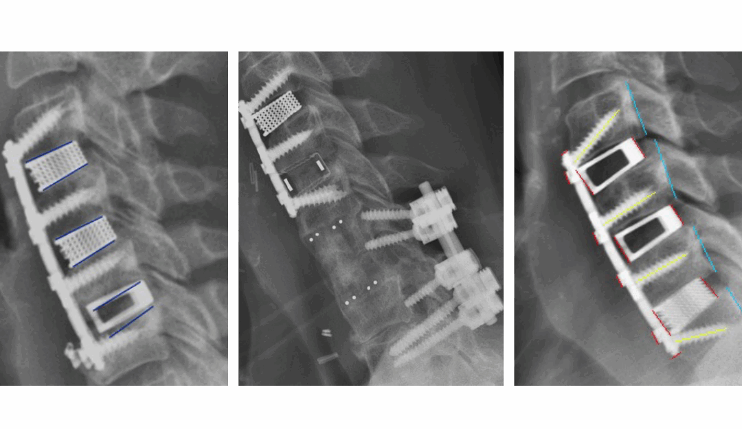 Nexus Spine’s Patented Tranquil® Interbody Implants Achieve Exceptional Outcomes