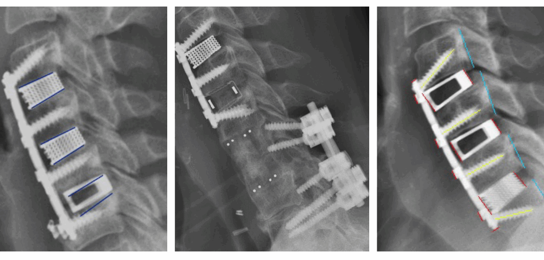Nexus Spine’s Patented Tranquil® Interbody Implants Achieve Exceptional Outcomes